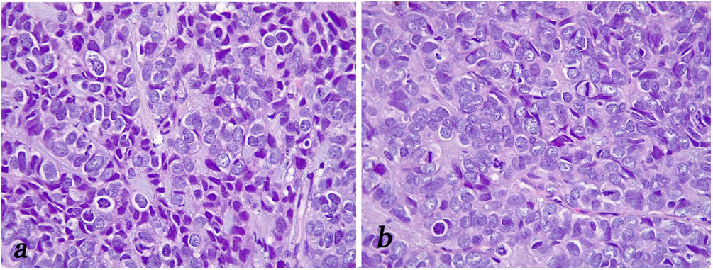 Vol 57   (1). Juan B. Laforga y col. Algoritmo diagnóstico para carcinoma sinonasal   papilar de células escamosas no queratinizante con fusión e imitadores de   DEK::AFF2.   elsevier.es/es-revista-rev…