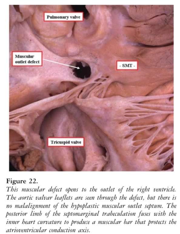 ZHeart11768530's tweet photo. 🔴 Classification of Ventricular Septal Defects for the Eleventh Iteration of the International Classification of Diseases—Striving for Consensus #openaccess 

https://t.co/MJ46P7AbhJ
#CardioEd #CardioTwitter #cardiology https://t.co/6wHZNLB62Z