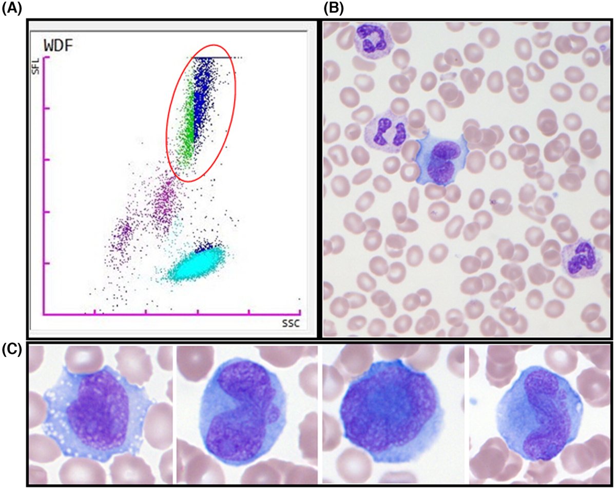 Massive circulating metastatic cells: A case of carcinocythemia - Farkh - 2024 - Clinical Case Reports - Wiley Online Library onlinelibrary.wiley.com/doi/10.1002/cc…