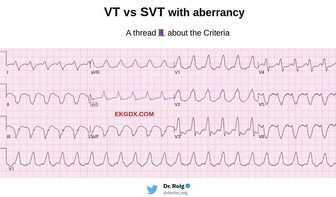 1/ Today's 🧵is about 'VT' versus 'SVT with aberrancy'. The aim of this thread is to provide basic tips on how to apply some of the most used criteria that might be helpful in diagnosing VT. #CardioTwitter Note that the following features are suggestive of VT, but their absence…