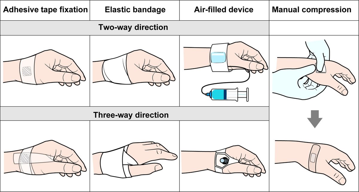 JACCJournals's tweet photo. #JACCINT study on distal radial access unveils high success rates in coronary procedures (100% CAG, 98.8% PCI). Few complications, low occlusion rates, and minimal bleeding events. https://t.co/Nwlo9mjEz8

#PCI #CAG #KODRA #CathLab https://t.co/chYQe30Bbb