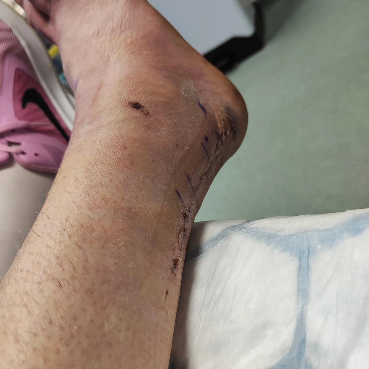 Post ankle surgery.  Have a listen to my podcast to hear about my recovery and journey back to running again. 
#orthapedics #anklesurgery #surgery #running