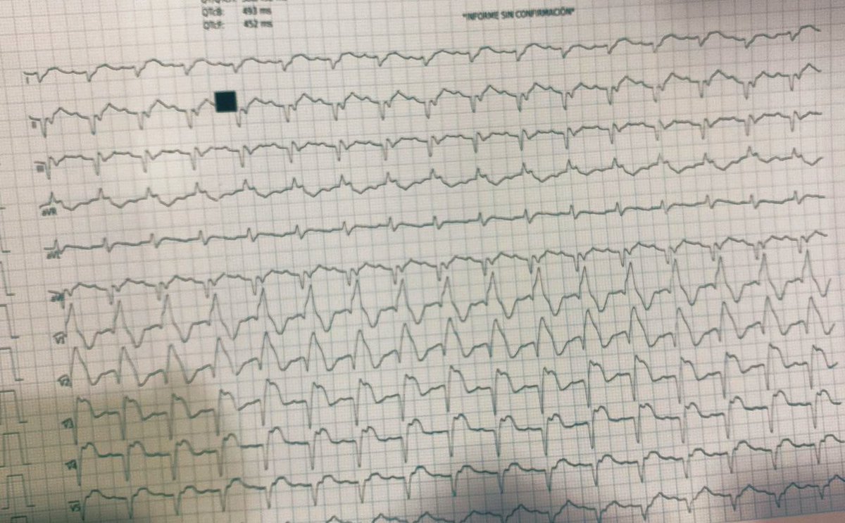 falsapelirroja's tweet photo. 🔴 Hombre, 73 años. HAS. DM2. 
🟡 Angina típica 16/02
🟡 Nuevo evento de angina, misma intensidad 17/02
Entre ambos eventos 18 horas de diferencia. 
🟡 Signos vitales iniciales FC 110 lpm, TA 60/40 mmHg 
Empieza lo bueno… 
#CardioTwitter 
1/ https://t.co/TR5MHsd5V6