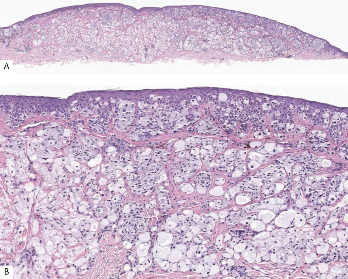 melanotic tumors Region of Interest Detection in Melanocytic Skin Tumor Whole Slide  ImagesNevus and Melanoma