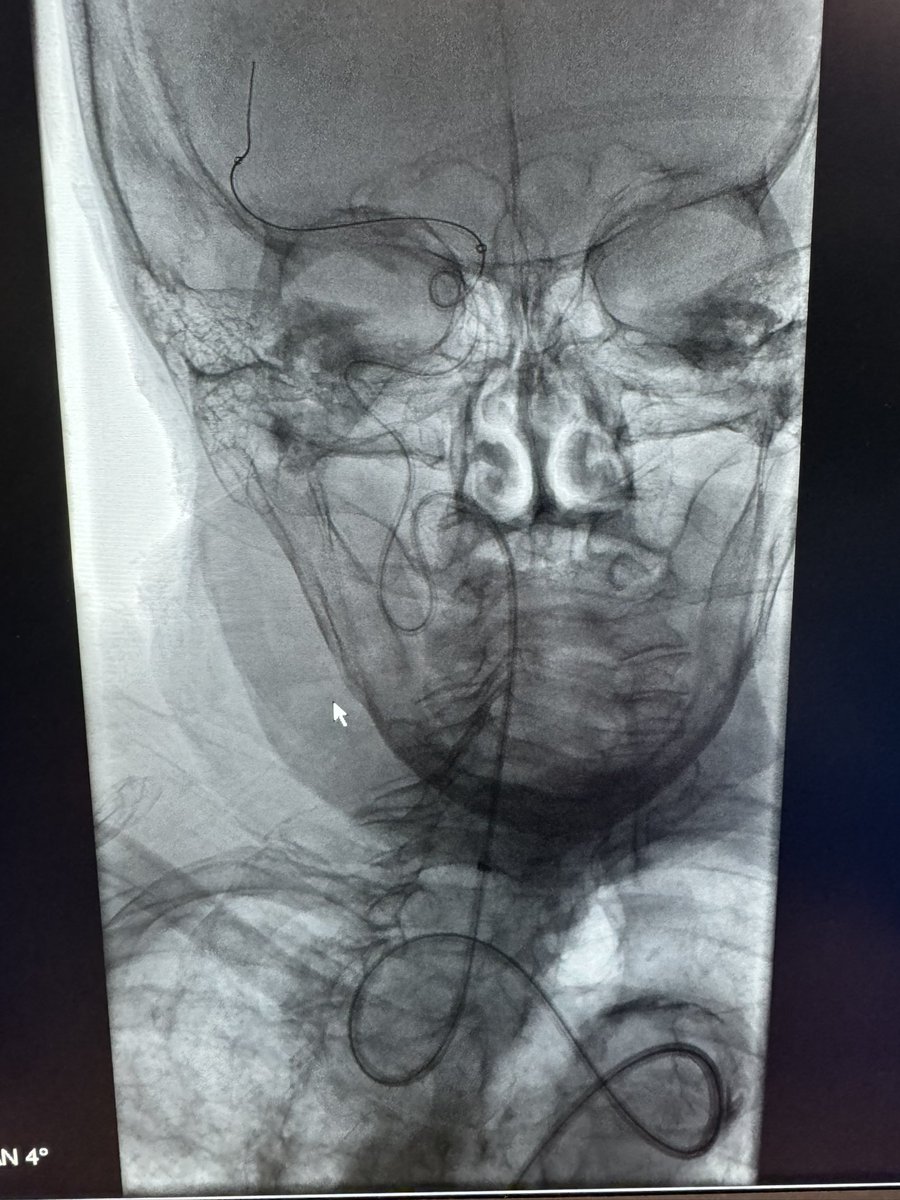 Sabeen Dhand (@sdhandmd) on Twitter photo <a href="/DonGarbettMD/">Don Garbett</a> <a href="/_backtable/">BackTable Vascular and Interventional</a> <a href="/ReNewVascular/">ReNew Institute</a> <a href="/joeyg132513/">joseph gemmete</a> Only crazy people keep fighting from groin 😂 <a href="/DonGarbettMD/">Don Garbett</a> <a href="/_backtable/">BackTable Vascular and Interventional</a> <a href="/ReNewVascular/">ReNew Institute</a> <a href="/joeyg132513/">joseph gemmete</a> Only crazy people keep fighting from groin 😂