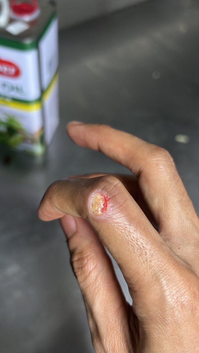 rivanfhrza's tweet photo. Jari kanan keslice mesin slicer, jari kiri kepotong piso yg baru d asah 🙂 https://t.co/Snwsq1AW2X
