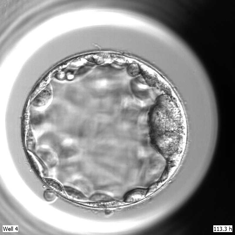 Here's one we made earlier! This beautiful blastocyst is now a beautiful baby boy!😍
A blastocyst is a 5 day old embryo. The cells around the outside will form the placenta & the large group of cells will form the baby
#FertilityFebruary
#FertilityFacts
#Blastocyst
#SuccessStory