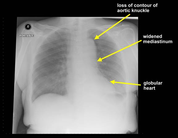 Gazal6849's tweet photo. 🟤𝘾𝙇𝙄𝙉𝙄𝘾𝘼𝙇 𝙎𝘾𝙀𝙉𝙀𝙍𝙄𝙊:-
💅A 60yr old♂️ known case of HTN presented with sudden severe tearing #chest_pain.
Upon examination there is #asymmetry of peripheral #pulses.
🩻X-ray chest is shown:
🏮What is likely #diagnosis❓❓
Pic: @ClevelandClinic https://t.co/BW4YmlJJvc