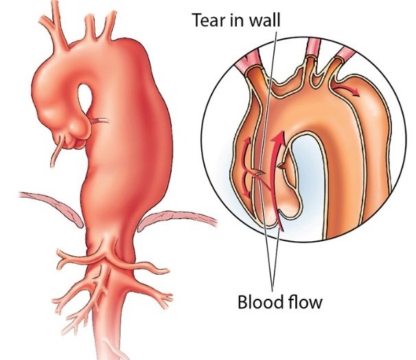 Gazal6849's tweet photo. 🟤𝘾𝙇𝙄𝙉𝙄𝘾𝘼𝙇 𝙎𝘾𝙀𝙉𝙀𝙍𝙄𝙊:-
💅A 60yr old♂️ known case of HTN presented with sudden severe tearing #chest_pain.
Upon examination there is #asymmetry of peripheral #pulses.
🩻X-ray chest is shown:
🏮What is likely #diagnosis❓❓
Pic: @ClevelandClinic https://t.co/BW4YmlJJvc
