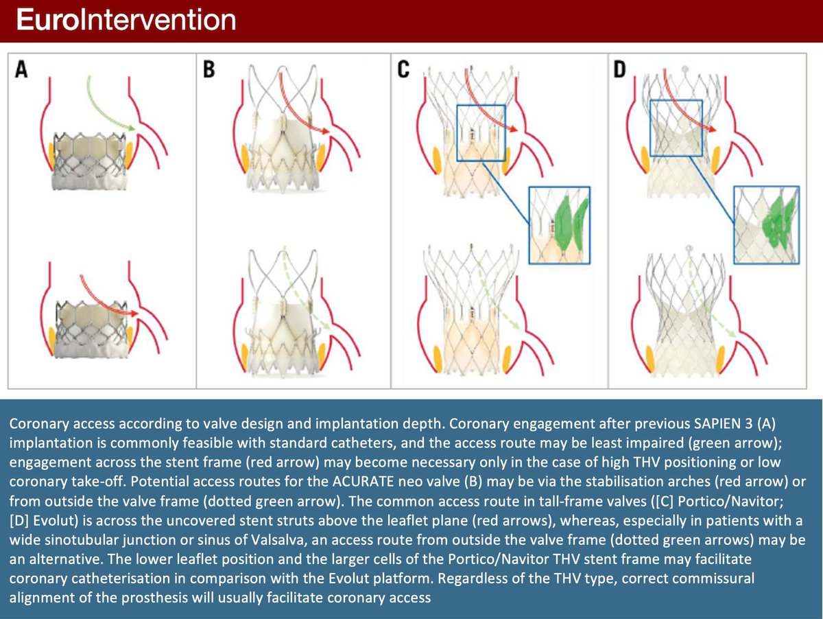 EuroInterventio's tweet photo. This clinical consensus statement proposed a rationale for the diagnostic evaluation and indications for percutaneous revascularisation of CAD in patients with severe aortic stenosis undergoing transcatheter treatment. #EIJBestOf https://t.co/2pJzl6z7eS https://t.co/qZzJ1SZOyX