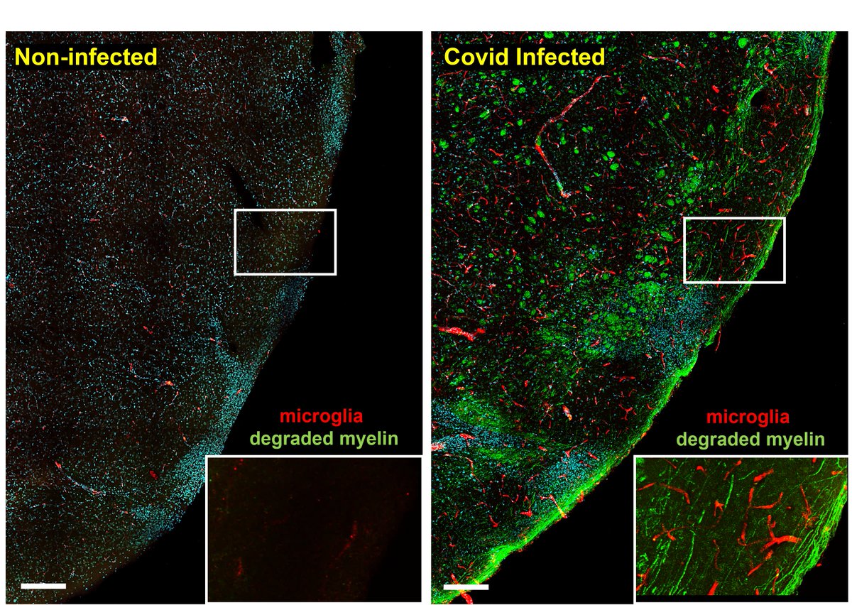 Myelin and Covid I often post high-magnification photos, so sometimes it is hard (even for me in the microscope) to have an idea of the big picture of the damage that a microorganism like #SARSCoV2 can cause in the brain. The photos below are a comparison of the same region in