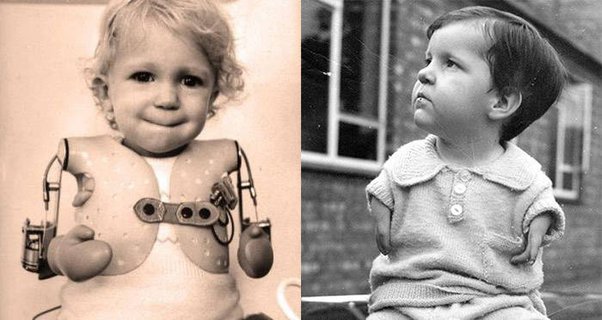 mariobianchi18's tweet photo. Il #19febbraio 1968 i produttori del #Talidomide (l'antinausea per le donne incinte) concordano con l'Alta Corte del Regno Unito il risarcimento per le famiglie di 62 bimbi nati con gravissime malformazioni. L'azienda Distillers Compagny verserà circa un mln e mezzo di sterline. https://t.co/9KCFGyIHhY