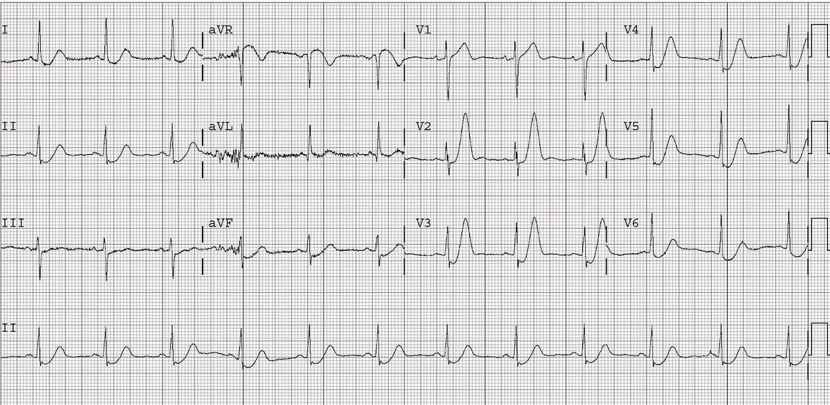 12_Derivaciones's tweet photo. 🏴 ECG para no olvidar en la guardia

❄️Patrón de De Winter, descenso ST en precordiales con T hiperaguda asociada, implica oclusión casi total de la descendente anterior proximal, se trata como un síndrome coronario agudo CON ELEVACIÓN del ST

💾 RJ de Winter et al, NEJM (2008) https://t.co/a4iF2TNp9w