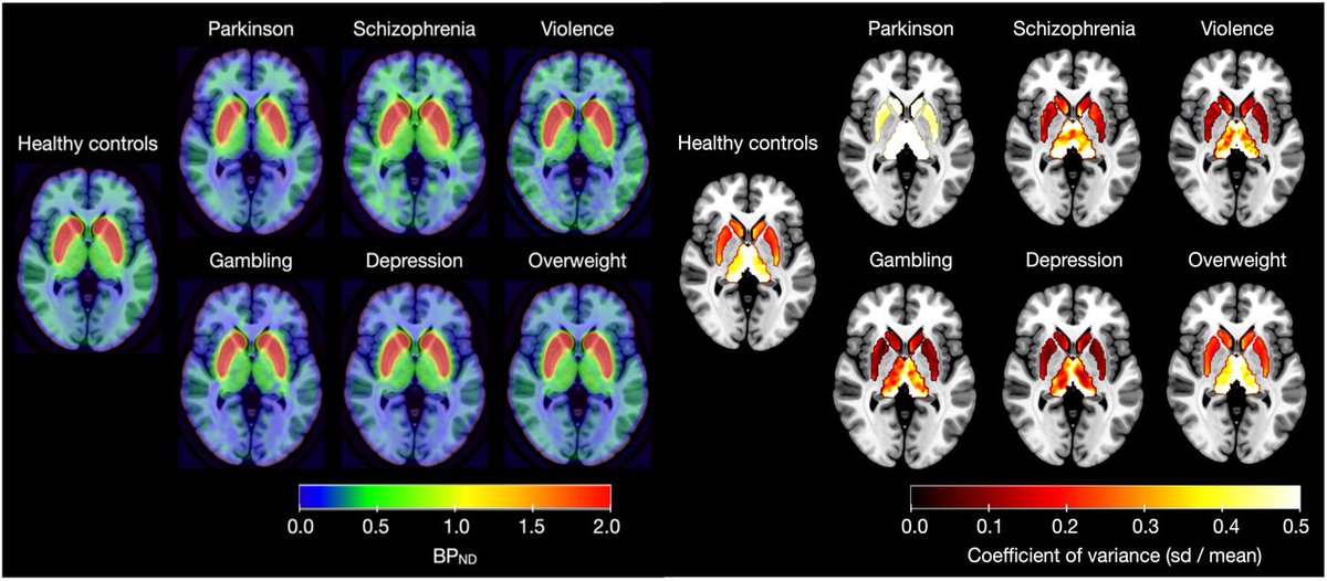 Dopamine modulates emotion, motivation and motor functions. New large-scale D2R maps (n=437) from @TurkuPETCentre show alterations in dopamine function and coupling across a wide range of neurological & psychiatric conditions - paper now out in @eic_nic ! doi.org/10.1016/j.nicl…