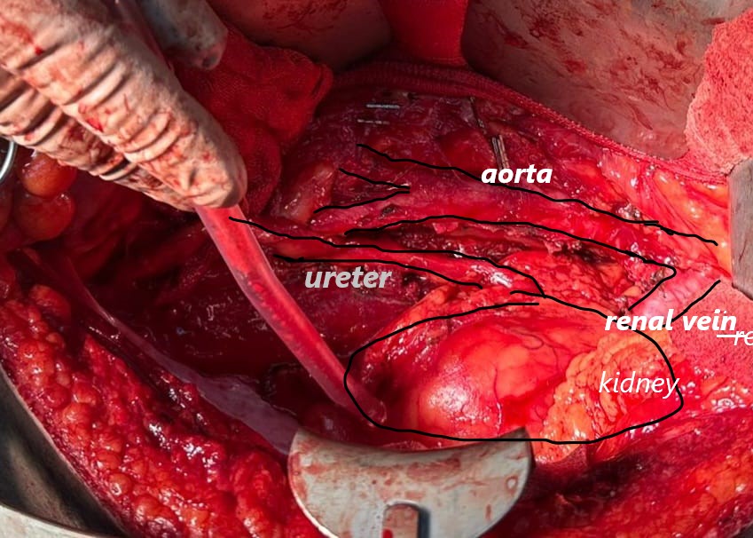 DrCihatt's tweet photo. Retroperitoneal lymph node dissection was successfully performed due to testicular cancer. #RPLND #Testicularcancer https://t.co/urecIqD8IN