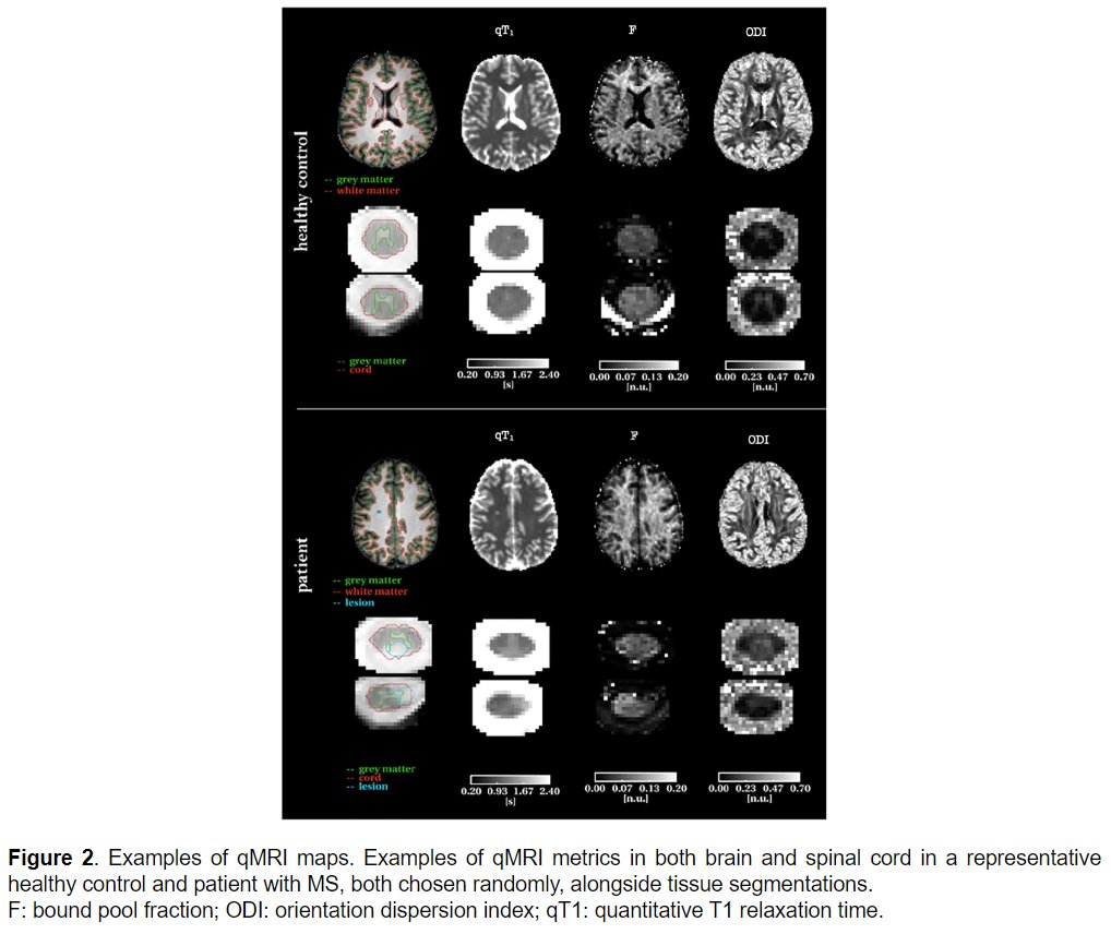 MSJ (@msj_research) on Twitter photo Fast brain-and-cord–matched quantitative MRI reflects demyelination and identifies physical/cognitive disability accumulation in progressive #MultipleSclerosis.
Study from <a href="/CarmenTur1/">Carmen Tur</a> <a href="/Claudia_WK/">Claudia WK</a> <a href="/QSMSCENTRE/">QueenSquareMSCentre</a> <a href="/UCLIoN/">UCL Queen Square Institute of Neurology</a> <a href="/UCLBrainScience/">UCL Brain Sciences</a> <a href="/cemcat_em/">Cemcat</a> <a href="/unipv/">Università di Pavia</a> ▶️ journals.sagepub.com/doi/10.1177/13… Fast brain-and-cord–matched quantitative MRI reflects demyelination and identifies physical/cognitive disability accumulation in progressive #MultipleSclerosis.
Study from <a href="/CarmenTur1/">Carmen Tur</a> <a href="/Claudia_WK/">Claudia WK</a> <a href="/QSMSCENTRE/">QueenSquareMSCentre</a> <a href="/UCLIoN/">UCL Queen Square Institute of Neurology</a> <a href="/UCLBrainScience/">UCL Brain Sciences</a> <a href="/cemcat_em/">Cemcat</a> <a href="/unipv/">Università di Pavia</a> ▶️ journals.sagepub.com/doi/10.1177/13…