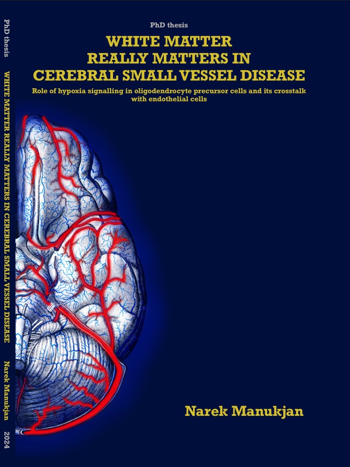 #thesisdefence Tomorrow, Narek Manukjan will defend the thesis 'White matter really matters in cerebral small vessel disease: Role of hypoxia signalling in oligodendrocyte precursor cells and its crosstalk with endothelial cells' at 10:00h @MaastrichtU 📺youtube.com/live/AxRWIn3yd…
