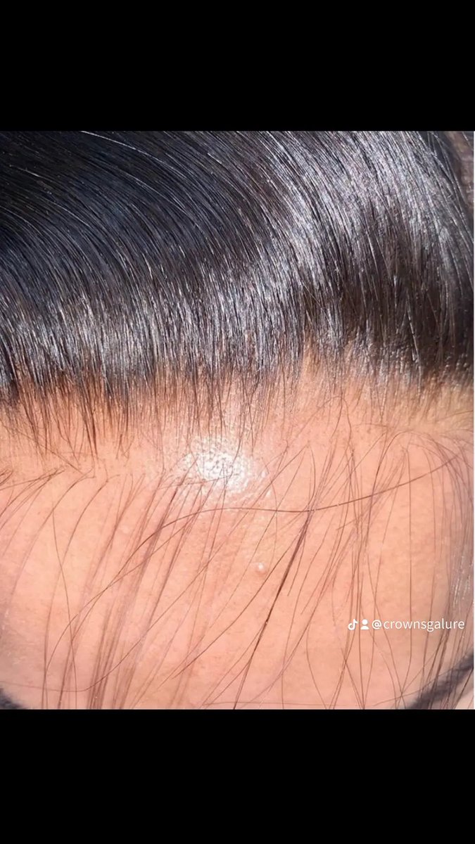 CrownsGalure's tweet image. Up Close and Personal 😌 Follow For More Exclusive Updates

🚨Raw Luxury Available. Check out our Valentine’s Day Sale. 
🚨25%off + FREE closure | Same Day Shipping 
Shop crownsgalure.com

#crownsgalure #hairextensions #closureinstall #hdlacewig  #explore #hairvendor