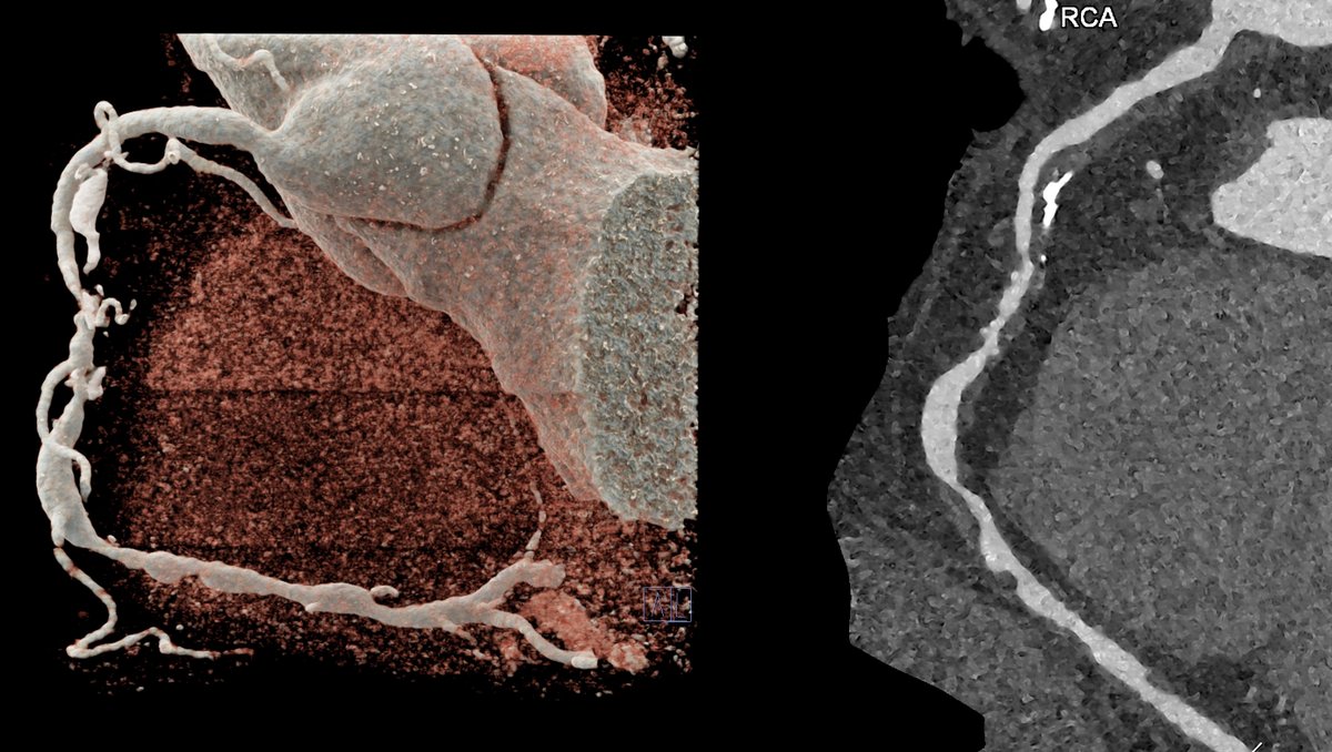 SOA PCCT - What can CT do for you and your patients? Nice 3DVR and longitudinal MPR of severely diseased RCA. Ex. from axial 1024x1024 matrix (FOV 140mm); source images 0.2/0.1mm; thickness/increment. Kernel Bv60. QIR level 4.