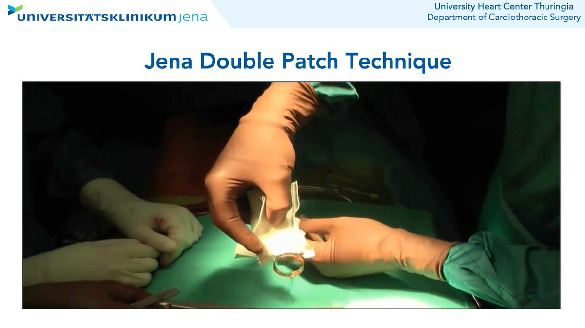 TulioCaldonazo's tweet photo. 👉Excited to showcase the long-term results of the Jena double patch technique.

👉Definitely a reproducible UFO-procedure in IE double valve cases with destruction on the intervalvular fibrous body. https://t.co/V1abs4MVmT
