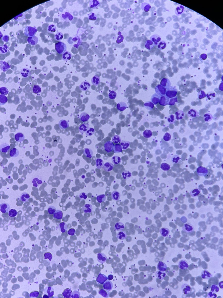 an_a91n's tweet photo. Wbc = 190000
What do you think ?!
#lab #hemato https://t.co/JAYy36tBaM