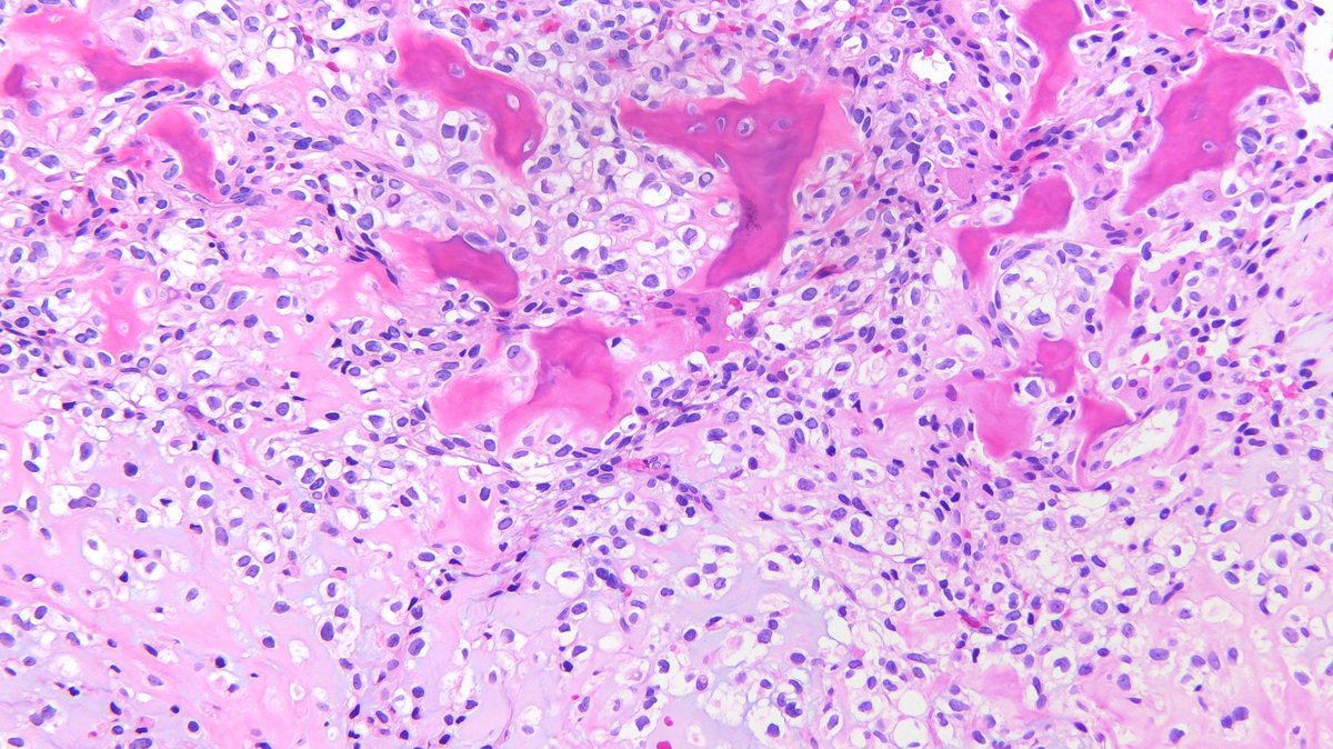 40-50's patient with a femoral head mass: classic morphology for this entity! #pathtwitter #surgpath #bstpath