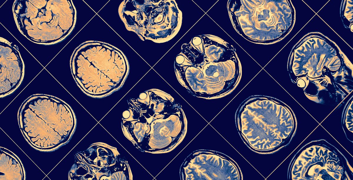 Medscape's tweet image. #Flavonoids have been proposed as an approach to reducing #Parkinsons disease risk, but new data showed no association of flavonoid intake with protective benefit. ms.spr.ly/6013c1oFT