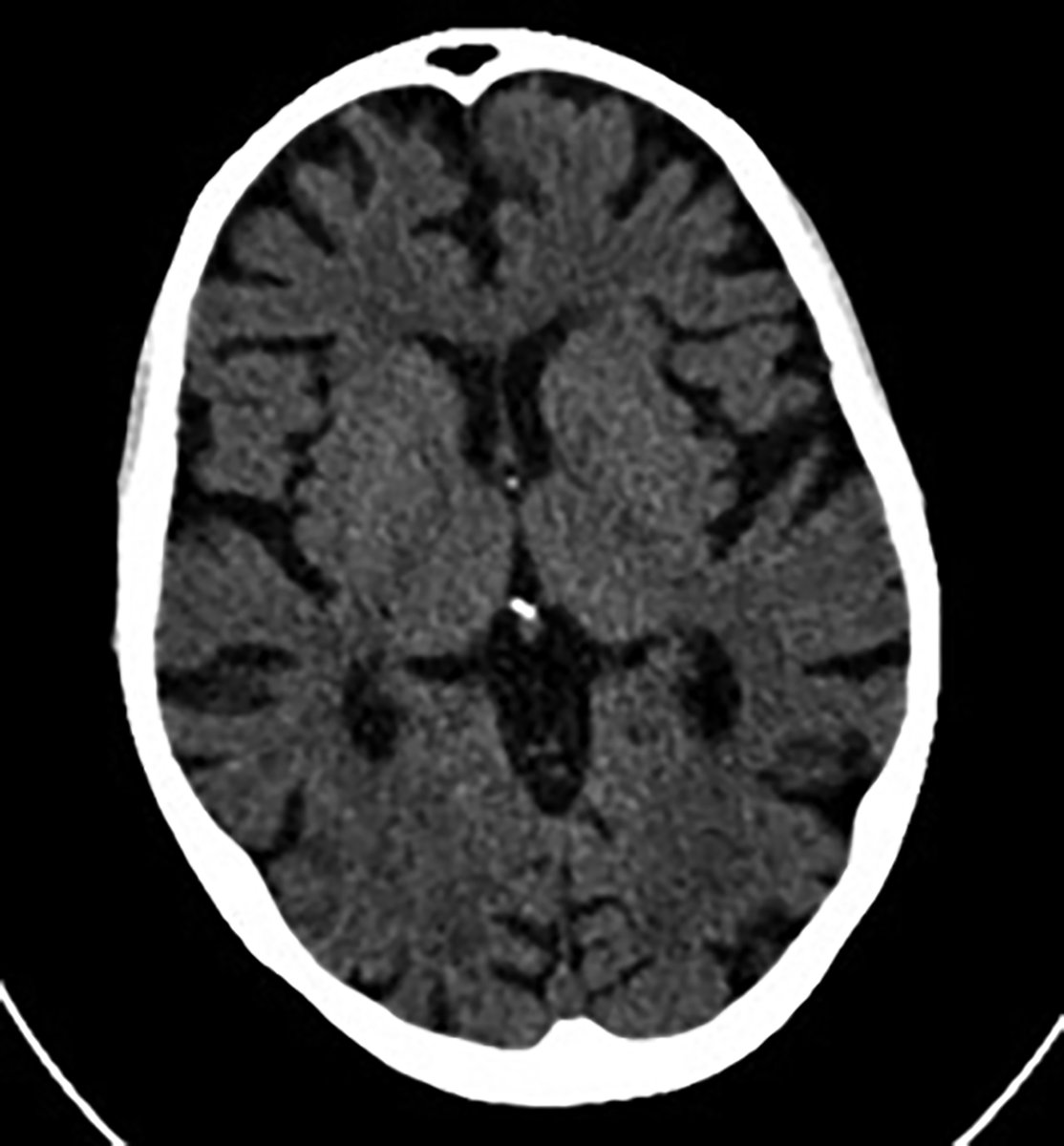 Complications of Anorexia Nervosa 

Learn more ➡️ bit.ly/42HZ3kK
#Radiology #Imaging #CaseStudy #RadEd #RadRes