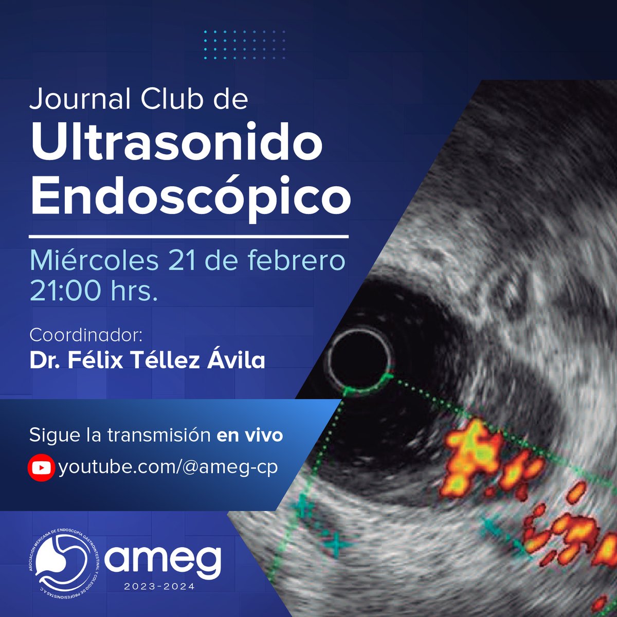 Te invitamos cordialmente al Journal Club de Ultrasonido Endoscópico, coordinado por el Dr. Félix Téllez Ávila. Acompáñanos para explorar y discutir las últimas tendencias y hallazgos en esta fascinante área. Miércoles 21 de Febrero | 21:00 hrs youtube.com/@ameg-cp/strea…