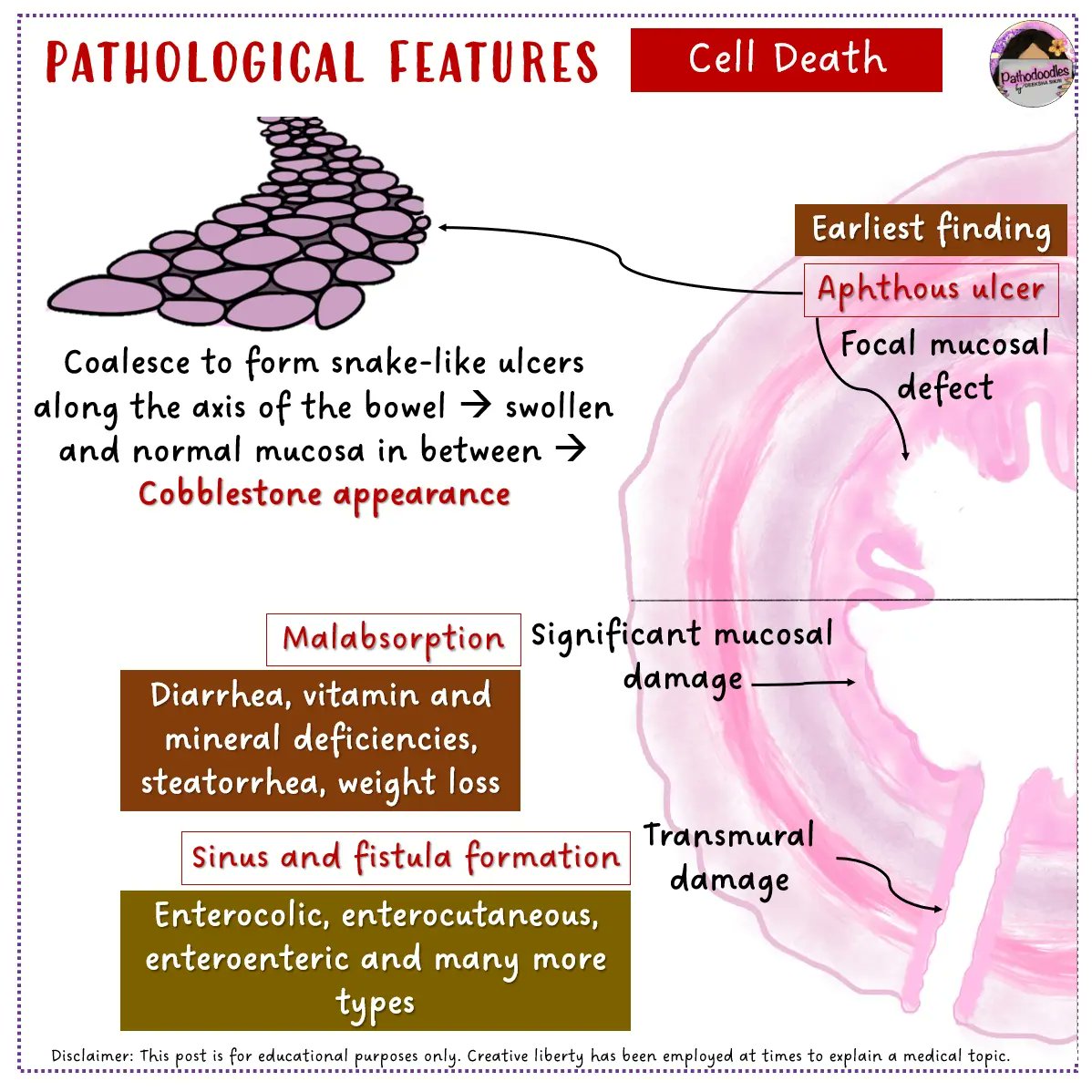 #Pathodoodles is back on #PathTwitter and #MedStudentTwitter with a new post on #GIPath - Crohn Disease and it's salient features.