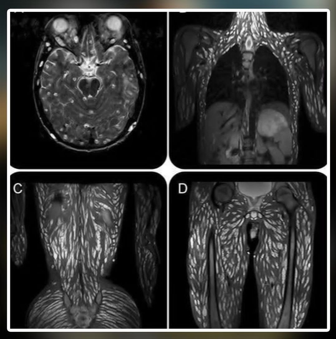 Se que estamos hablandod e carne picada de vaca  Q NO HAY Q DARLE A MENORES pero me cruce con esta imagen de alguien q comia cerdo jugoso (crudo)  cada cosito blanco es una larva o gusano🙃