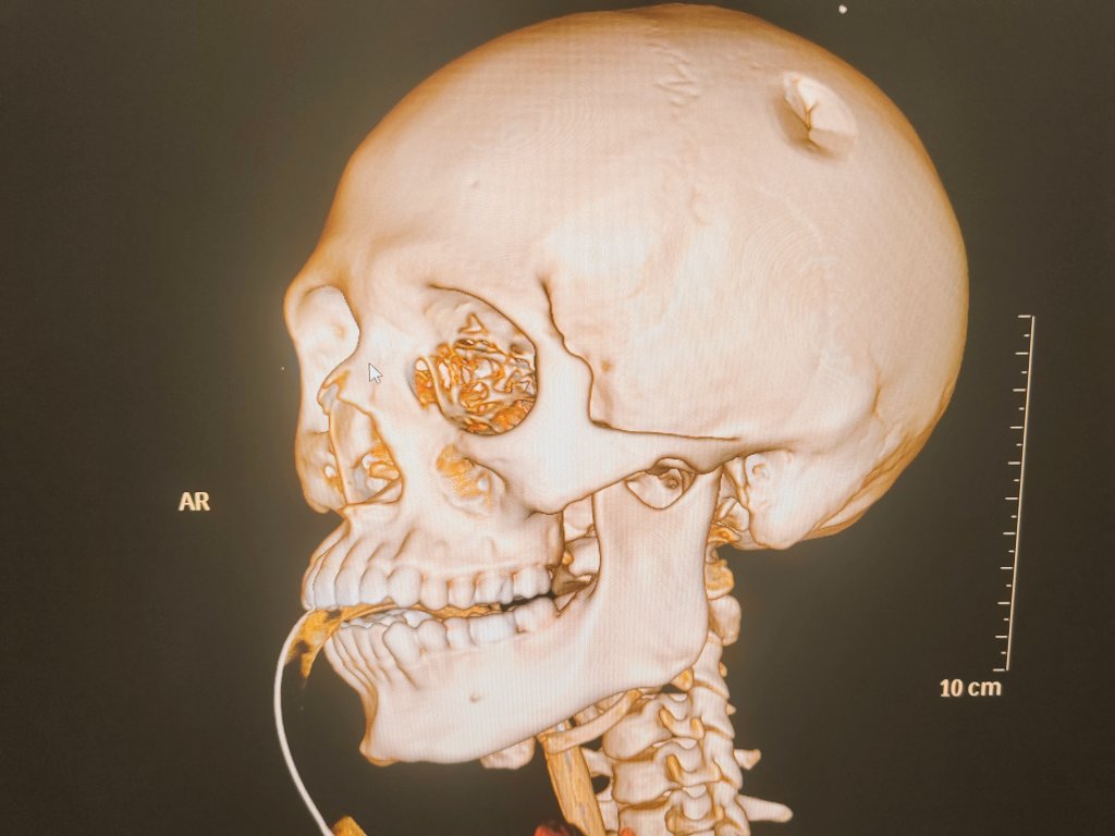 DSPedia21's tweet photo. Traumatismo cráneo encefálico https://t.co/WuImS1jAwW