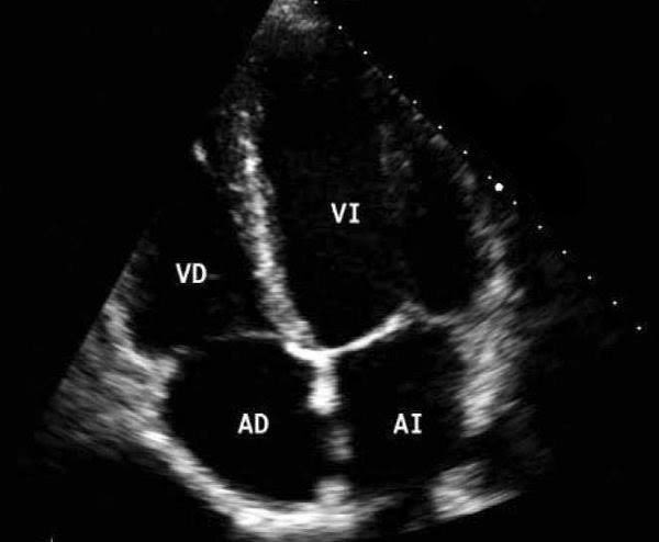 EmergPOCUS's tweet photo. 🎯 🫀 Hoy Aprendamos las #Ventanas Básicas 2D en #Ecografía Cardiaca Transtoracica🫀 🎯
🧶🧵(HILO)🧵🧶
Estas son:
•Ventana #Parasternal Eje Largo
•Ventana #Parasternal Eje Corto
•Ventanas #Apicales de 4 y 5 Cámaras
•Ventana #Subcostal de 4 Cámaras
•Ventanas #Subcostales en Eje Corto (Incluyendo la de Vena Cava Inferior)
La idea mis panas es mejorar nuestra habilidad para realizar e interpretar ecografías cardíacas, reconociendo cada ventana y su importancia en el diagnóstico y tratamiento para nuestros pacientes. 🌟
Este 🧵 es solo un mini resumen 📋 hecho para avivar el interés 🔥, difundir 🌍, recordar 🗝️ y mejorar nuestras habilidades en ecografía cardíaca . Si deseas ampliar aun mas tu conocimiento 📚, te animo a leer más al respecto. En mi caso, este resumen fue basado en: https://t.co/KIXhFsHFrI…. Espero te sea útil y te inspire a seguir aprendiendo.