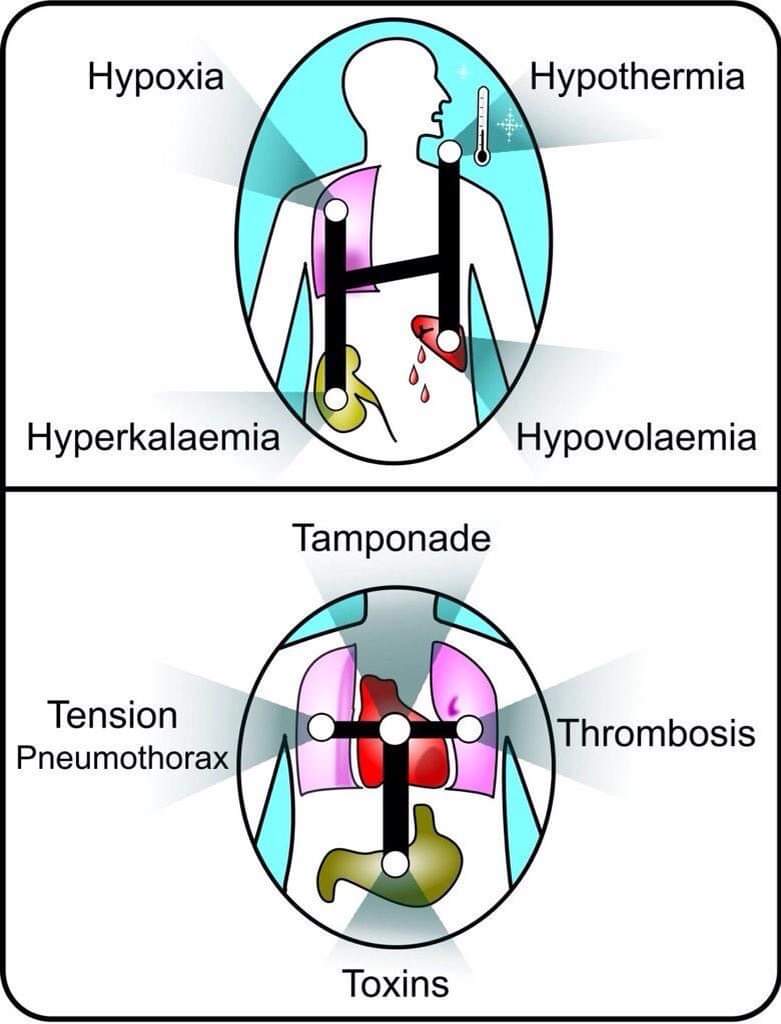 Reversible causes of cardiac arrest 
The H &amp; Ts 

Subscribe 👇
youtube.com/@pgmedicine2023