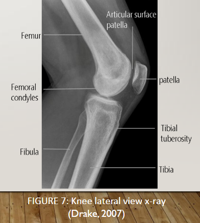 膝蓋骨(patella)の位置はもう少し上側かもしれません。1枚目がレントゲン、2枚目がMRIの画像です。
https://t.co/GiNjtqoR9l

3枚目は完全屈曲膝関節のMRIです。
https://t.co/jwCi2scpbl

4枚目はReal time MRIでの膝関節屈曲の様子です。
https://t.co/3F844TTgdS 