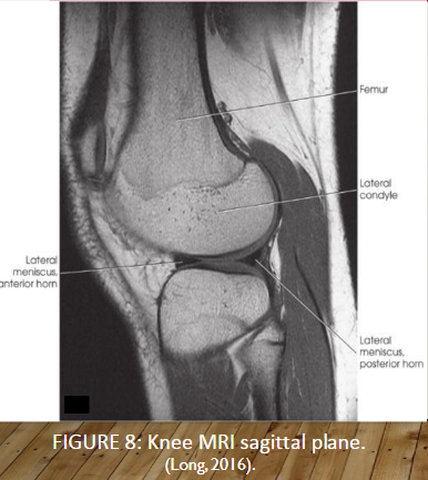膝蓋骨(patella)の位置はもう少し上側かもしれません。1枚目がレントゲン、2枚目がMRIの画像です。
https://t.co/GiNjtqoR9l

3枚目は完全屈曲膝関節のMRIです。
https://t.co/jwCi2scpbl

4枚目はReal time MRIでの膝関節屈曲の様子です。
https://t.co/3F844TTgdS 