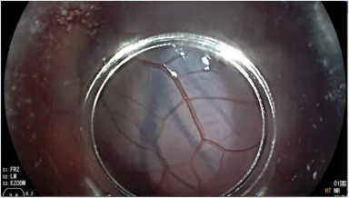 iGIE (@igiejournal) on Twitter photo In iNNOVATIONS from the latest issue of iGIE: Weitzner et al give a "Demonstration of feasibility and technique of transesophageal endoscopic epicardial access in a porcine model." igiejournal.org/article/S2949-…
<a href="/ZachWeitznerMD/">Zach_Weitzner_MD</a>
<a href="/MetabolicEndo/">Chris Thompson, MD</a> <a href="/gutdoc18/">Janese Laster, MD</a> In iNNOVATIONS from the latest issue of iGIE: Weitzner et al give a "Demonstration of feasibility and technique of transesophageal endoscopic epicardial access in a porcine model." igiejournal.org/article/S2949-…
<a href="/ZachWeitznerMD/">Zach_Weitzner_MD</a>
<a href="/MetabolicEndo/">Chris Thompson, MD</a> <a href="/gutdoc18/">Janese Laster, MD</a>