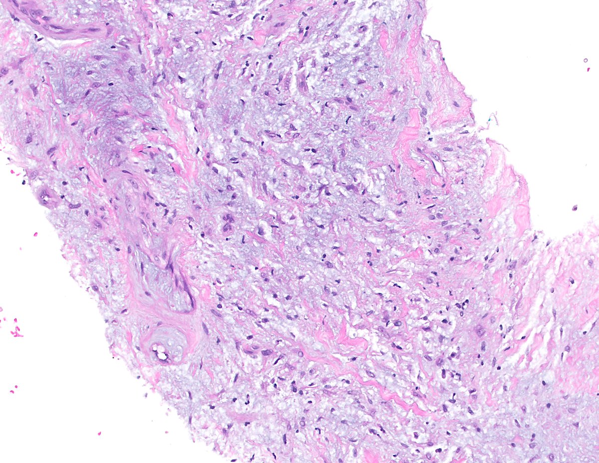 It's calcified, it's chondroid, it's mesenchymal...what's not to like?  #BSTpath  

pubmed.ncbi.nlm.nih.gov/37102574/