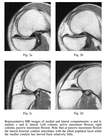 膝蓋骨(patella)の位置はもう少し上側かもしれません。1枚目がレントゲン、2枚目がMRIの画像です。
https://t.co/GiNjtqoR9l

3枚目は完全屈曲膝関節のMRIです。
https://t.co/jwCi2scpbl

4枚目はReal time MRIでの膝関節屈曲の様子です。
https://t.co/3F844TTgdS 