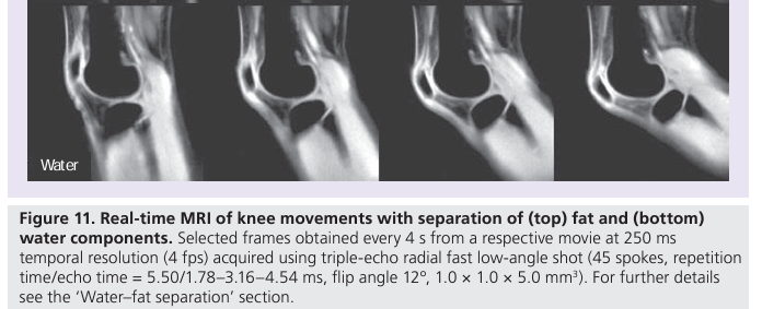 膝蓋骨(patella)の位置はもう少し上側かもしれません。1枚目がレントゲン、2枚目がMRIの画像です。
https://t.co/GiNjtqoR9l

3枚目は完全屈曲膝関節のMRIです。
https://t.co/jwCi2scpbl

4枚目はReal time MRIでの膝関節屈曲の様子です。
https://t.co/3F844TTgdS 