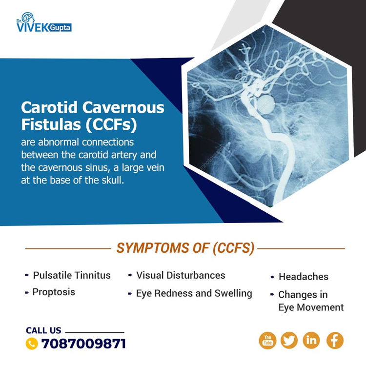 doctorvivekg's tweet image. Unlock the mystery of Carotid Cavernous Fistulas (CCFs) – abnormal connections between the carotid artery and the cavernous sinus. Explore symptoms as mentioned.
bit.ly/3XbZJvJ
#CarotidCavernousFistulas #CCFs #carotidartery #cavernoussinus #visualdisturbance