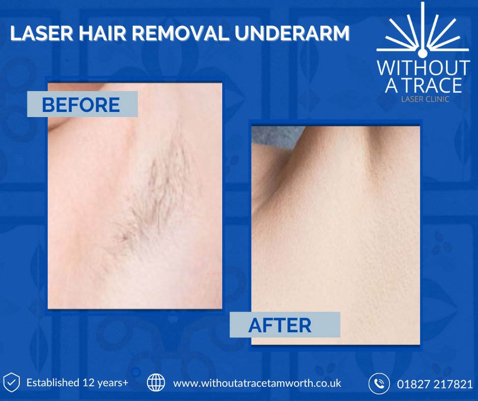✨ Witness the power of Precision Pain-Free Laser Hair Removal with our incredible before and after images of underarm hair removal! Don't miss out on your chance for a hair-free future!  💫 #LaserHairRemoval #BeforeAndAfter Book a FREE consult today: bit.ly/freelaserhairc…