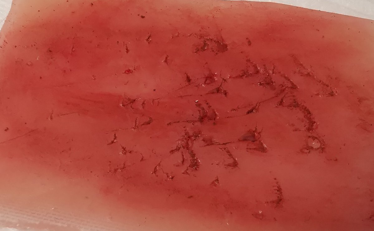 bergblumba's tweet image. Nobrāzumus, dažādus sadzīves griezumus ir droši tīrīt ar ūdeni un ziepēm, vai izmantot kādu dezinfekcijas līdzekli, kas nesatur alkoholu.

❗Nē ūdeņraža peroksīdam, alkoholu saturošiem dezinfekcijas līdzekļiem (tostarp briljantzaļais). Tie bojā audus, neveicina dzīšanu.