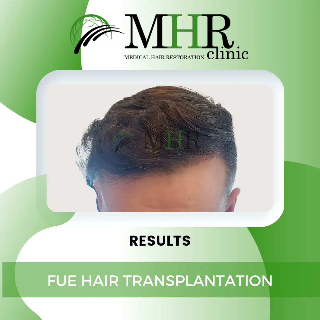 Mhr_clinic's tweet photo. 👨‍🦰Unveiling the incredible results of a FUE Hair Transplantation journey after 10 months! ✨️ Witness the transformation from before and now, and the confidence that comes with it. 
If you're considering a hair transplant transformation, get in touch to book a Free Consultation https://t.co/hZmWguqC52
