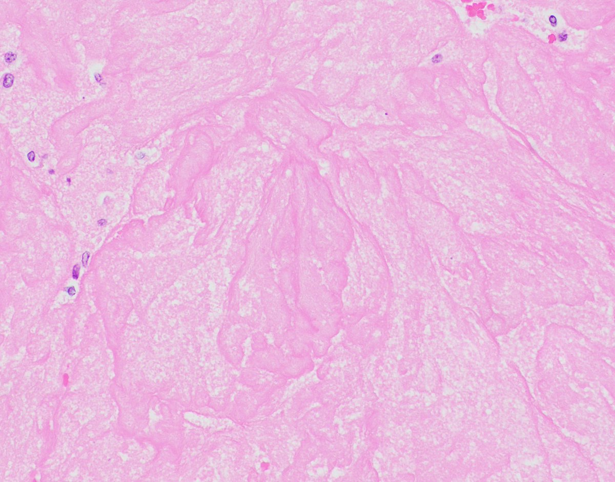 bitar_mireille's tweet photo. #autopsy finding..
location?
histology?
lesion type?
some risk factors? 🤔

#cardiacpath #pathology #hemepath #heartpath #pathtwitter https://t.co/u2cZADJcHr