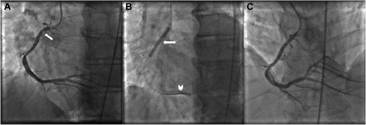 MyJSCAI (@myjscai) on Twitter photo 🆕📚 Off-Label Use of Peripheral Paclitaxel #DCB in Management of Recurrent Coronary #ISR.
➡️doi.org/10.1016/j.jsca…
<a href="/MVMadhavanMD/">Mahesh V. Madhavan, MD, MS</a> <a href="/JWMoses/">Dr. Jeffrey W. Moses</a> <a href="/EmadHakemiMD/">Emad Hakemi MD MS</a> <a href="/erin_flattery/">Erin Flattery</a> <a href="/drmeghaprasad/">Megha Prasad MD MS</a> <a href="/ziadalinyc/">Ziad Ali</a> <a href="/sahilparikhmd/">Sahil A. Parikh, MD</a> <a href="/Amisha_PatelMD/">Amisha Patel</a> 🆕📚 Off-Label Use of Peripheral Paclitaxel #DCB in Management of Recurrent Coronary #ISR.
➡️doi.org/10.1016/j.jsca…
<a href="/MVMadhavanMD/">Mahesh V. Madhavan, MD, MS</a> <a href="/JWMoses/">Dr. Jeffrey W. Moses</a> <a href="/EmadHakemiMD/">Emad Hakemi MD MS</a> <a href="/erin_flattery/">Erin Flattery</a> <a href="/drmeghaprasad/">Megha Prasad MD MS</a> <a href="/ziadalinyc/">Ziad Ali</a> <a href="/sahilparikhmd/">Sahil A. Parikh, MD</a> <a href="/Amisha_PatelMD/">Amisha Patel</a>