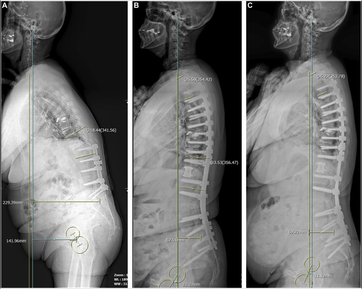 #ONSNew Gravity Line–Hip Axis Offset as a Guide for Global Alignment to Prevent Recurrent Proximal Junctional #Kyphosis/Failure bit.ly/3UNFqpM by Hyun et al @jwleecenter @JohnHShinMD @Zaazoue @CNS_Update @DKondziolkaCNS #Proximaljunctionalfailure