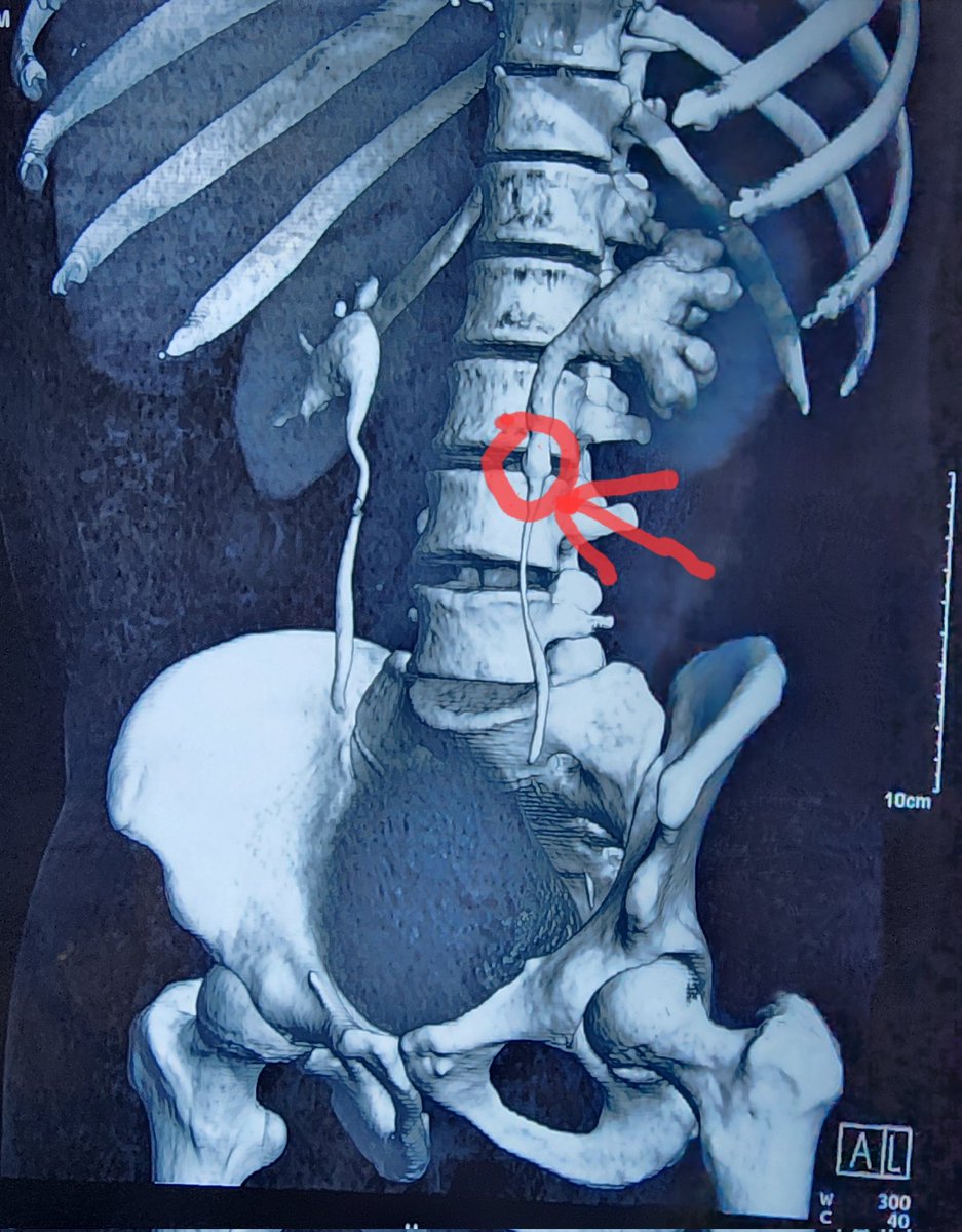 How to go about Impacted Upper ureteric stones... a thread 
1. Start with  Semirigid Ureteroscopy, try to pass a terumo guide wire across the stone into PCS. Place tip of guidewire between stone and ureteric mucosa and guide it across..