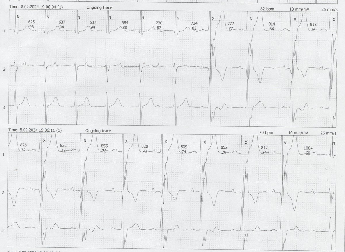 What diagnostic information can be retrieved from the Holter #ECG tracing? @selinynd @Mkara_EP @ElifhandeMD @DuyguKocyigitMD @AhmetKorkmaz07A @drfiratozcan @prof_serkan_cay @ozcanozeke @EF_Cardiaca @ecgandrhythmRoe @The_Nanashi_O @adribaran @DursunAras2 @topaloglu_prof