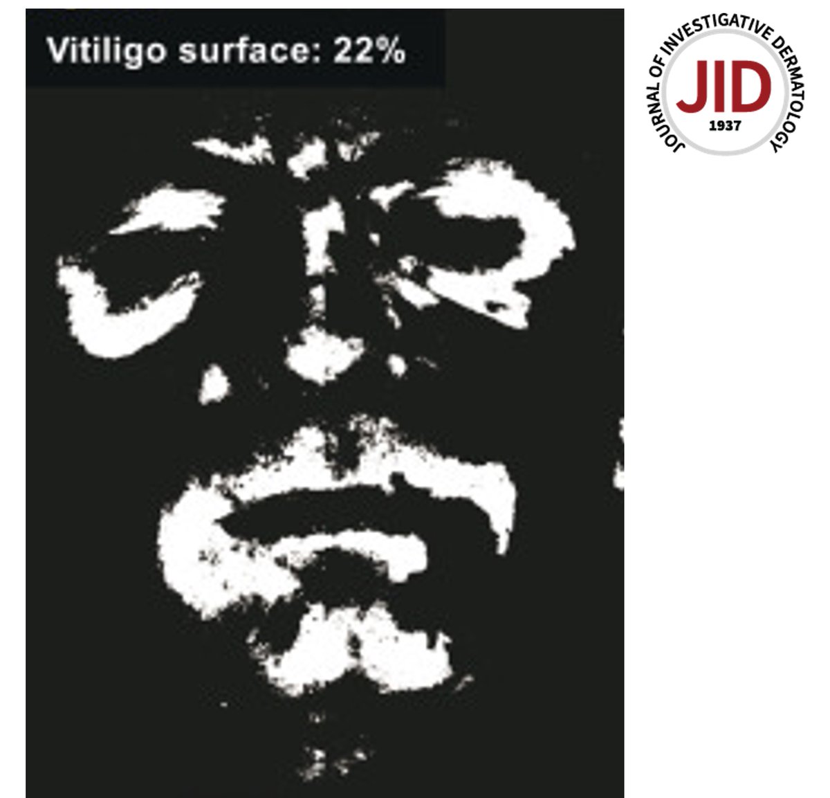 This study provides a reliable and objective tool to assess facial #vitiligo severity with a mixed clinical and #artificialintelligence approach, reports Hillmer et al. doi.org/10.1016/j.jid.… #derm #dermatology #dermatologist #dermatologists #dermatologia #dermatologie #AI